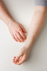 Male hands on white table with red spots on skin. Allergic reaction, skin problems, dermatology. Wrong diet, side effect from taking meds