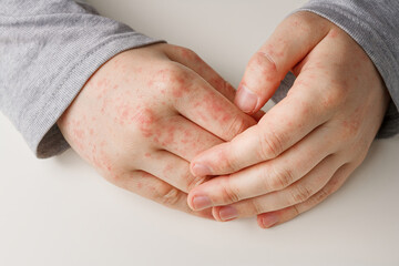 Male hands on white table with red spots on skin. Allergic reaction, skin problems, dermatology. Wrong diet, side effect from taking meds