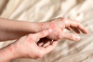 Itching on hands with redness rash. Cause of itchy skin include dermatitis (eczema), dry skin, burned, food,drug allergies, insect bites. Health care concept. - obrazy, fototapety, plakaty