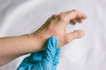 Doctor in blue gloves examines on hands with redness rash. Cause of itchy skin include dermatitis (eczema), dry skin, burned, food, drug allergies, insect bites. Health care concept.