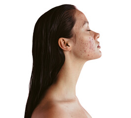 Young woman with inflammatory acne isolated on a transparent background