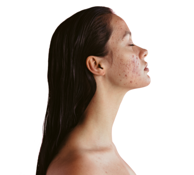 Young woman with inflammatory acne isolated on a transparent background