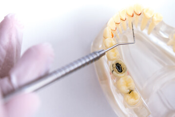 doctor orthodontist shows the instrument on caries in the teeth