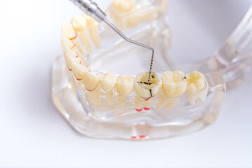 doctor orthodontist shows the instrument on caries in the teeth