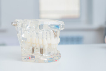 A model of teeth with implants lies on a table