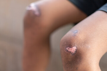 wound healing scar on kid knee from accident in daily life. health relation image for healthy content.