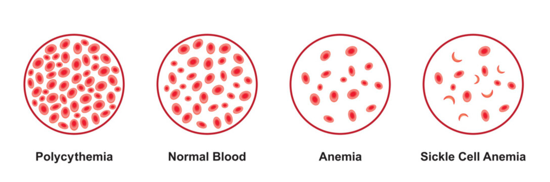 Scientific Designing of Blood Anomalies. Comparison Between Polycythemia, Anemia and Blood Sickle Anemia. Colorful Symbols. Vector Illustration.