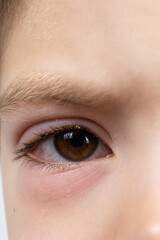 Eye of a child with conjunctivitis, inflammation of the conjunctiva, close-up.