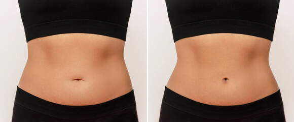 Two shots of a woman's belly with excess fat and toned slim stomach before and after navel correction. Plastic surgery on the bellybutton. Abdominoplasty, umbilicoplasty, lifting concept - obrazy, fototapety, plakaty