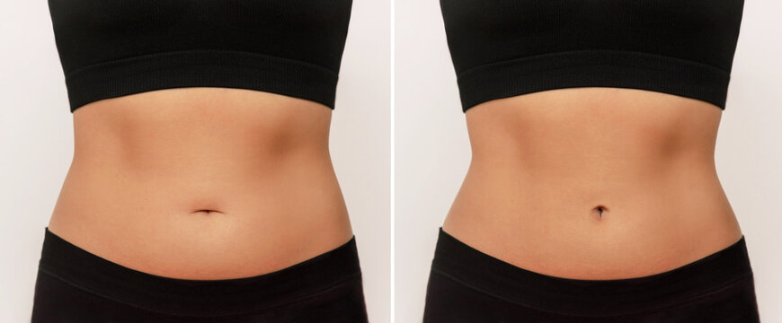 Two shots of a woman's belly with excess fat and toned slim stomach before and after navel correction. Plastic surgery on the bellybutton. Abdominoplasty, umbilicoplasty, lifting concept