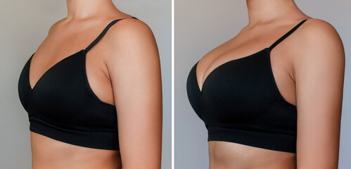 Young tanned woman in bra before and after breast augmentation with silicone implants. The result...