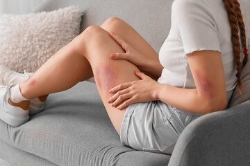 Young woman with bruised leg sitting on sofa at home