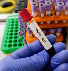Blood sample for TNF-α(Tumor necrosis factor alpha) test, an inflammatory cytokine produced by macrophages or monocytes during acute inflammation. - obrazy, fototapety, plakaty