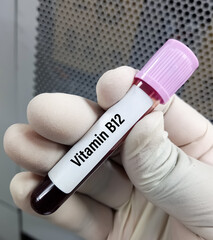 Blood sample for Vitamin B12(Cobalamin) test, to diagnose Vitamin B12 deficiency.