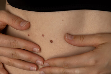 Unrecognizable woman showing her Birthmarks on skin Close up detail of the bare skin Sun Exposure...