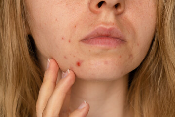 Unrecognizable woman showing her acne on face. Close-up acne on woman's face with rash skin ,scar...