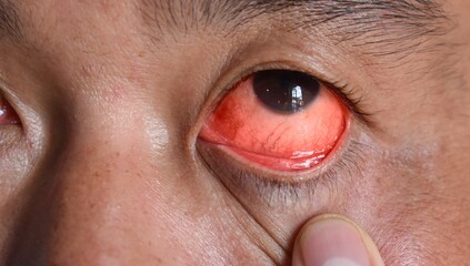 Corneal infection or ulcer called keratitis in Asian man. - obrazy, fototapety, plakaty