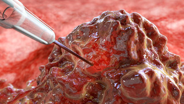 Oncolytic viral therapy, conceptual illustration