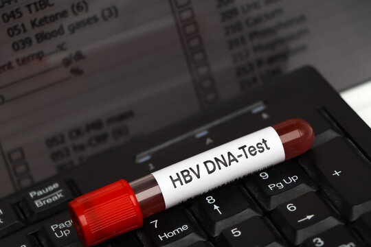  HBV DNA Test test to look for abnormalities from blood