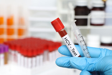 HCV Test to look for abnormalities from blood