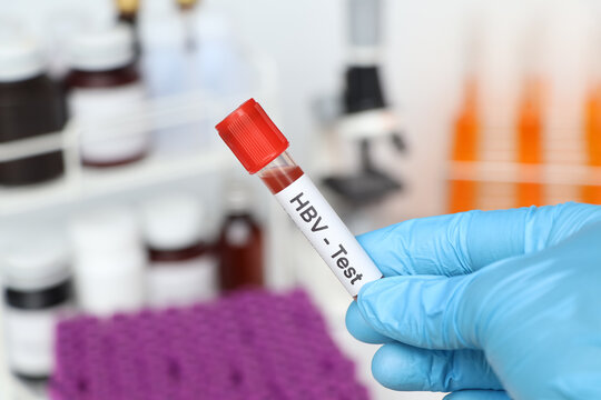 HBV Test to look for abnormalities from blood