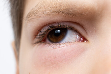 Eye of a child with conjunctivitis, inflammation of the conjunctiva, close-up.