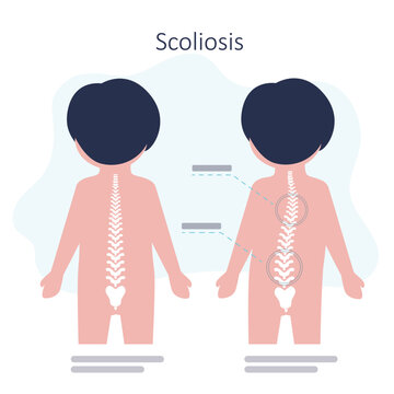 Educational Poster With Schoolboy Have Scoliosis Problems. Child With Disorders Of Musculoskeletal System. Example Of Strong Scoliosis. Spinal Curvature Concept. Back View.