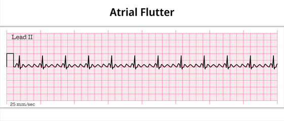 ECG Atrial Flutter - 8 Second ECG Paper
