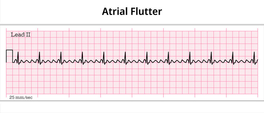 Atrial Flutter