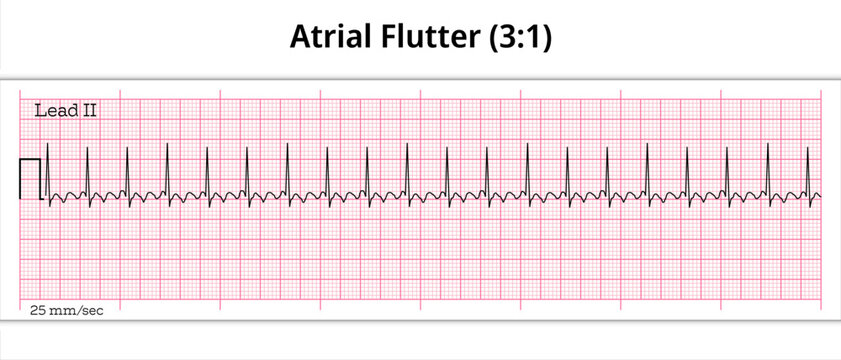 ECG Atrial Flutter (3:1)- 8 Second ECG Paper