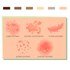 Psoriasis Vector Art