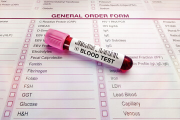 Blood testing from a patient on the test request form requested by the doctor for medical review....