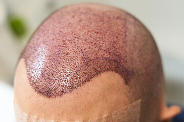 Detail of hair line after hair transplant surgery to cure baldness at clinic