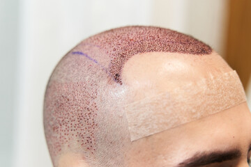 End to baldness concept. Male scalp after hair implant surgery