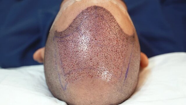 Top view of scalp after hair transplant surgery
