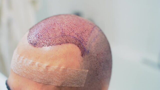 Detail of hair line after hair transplant surgery to cure baldness at clinic