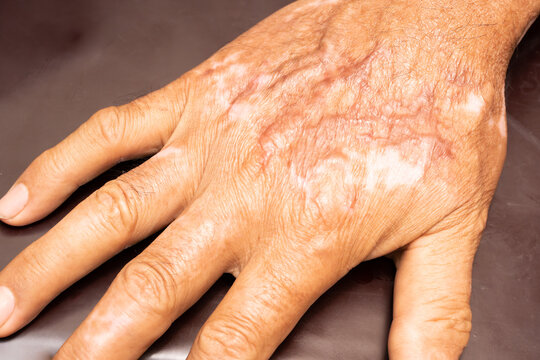 Burn Scars on the hands, Picture of the scar caused by an accident And has a smooth surface. Scarred hand, burnt skin, recovery.
