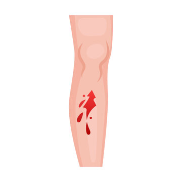 open wound on leg, heart. Traumas of skin on body part. Vector illustration of open cut wounds with bleeding, fracture and bruise. Cartoon isolated on white