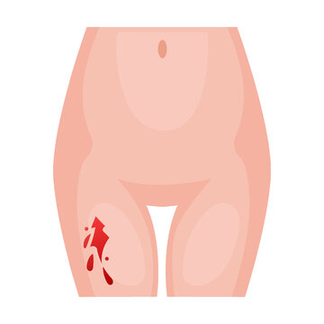 deep cut on leg. Traumas of skin on body part. Vector illustration of open cut wounds with bleeding