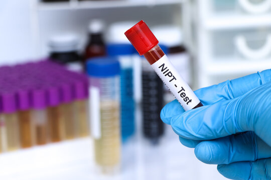 NIPT test to look for abnormalities from blood