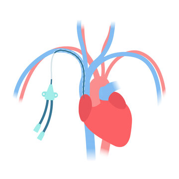 Tunneled Central Venous Catheter Placed In The Subclavian Vein. Patient With CVC Long Term Access Device For Chemotherapy Infusions And Blood Sampling. Central Line Tube Close Up. Vector Illustration.