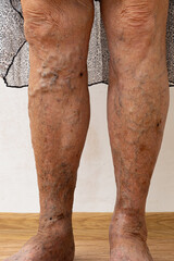 Vertical unrecognizable senior woman bare legs with protruding varix, spider varicose veins medical...