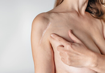 Woman have scar on shoulder over white background. Installation of a metal plate after fracture....