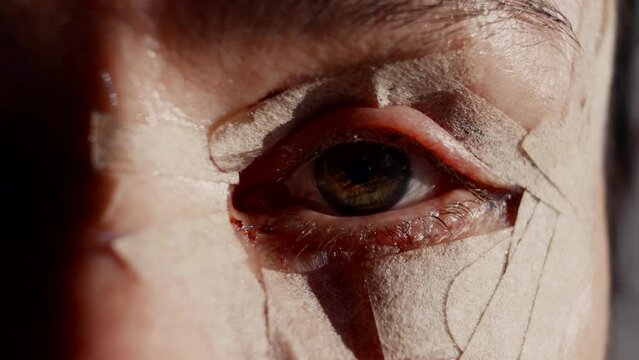 Close-up of the eyes after blepharoplasty. Recovery after plastic surgery on a woman face to change the eye area of the face.