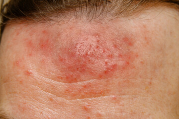 Fototapeta premium The skin on the forehead is affected by the iron mites (Demodex) Parasitic skin disease - demodicosis. Close-up.