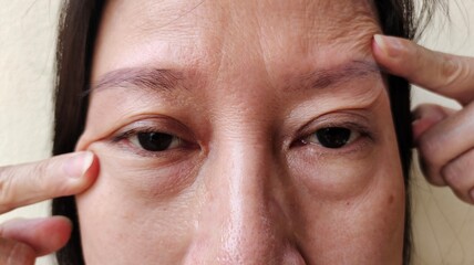 portrait the fingers holding the flabbiness adipose sagging skin, ptosis and flabby skin beside the eyelid, cellulite and bag under the eyes, problem freckles and blemish on the face of woman's