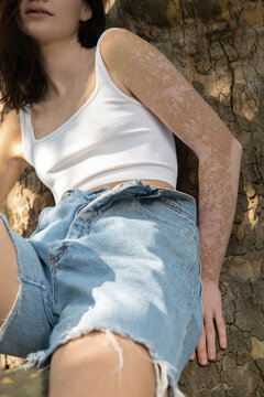 Portrait of woman with spotted skin outdoors