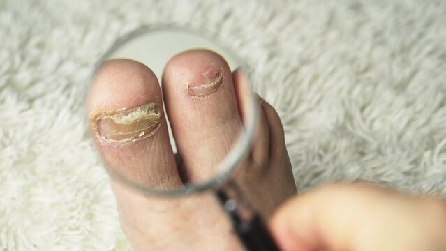 A man examines with a magnifying glass a toenail affected by a fungus. Close-up. Treatment of mycoses.