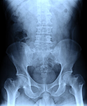 x-ray images of spine,pelvis,hip joint of patient by mri