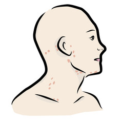 Redness Skin Lesions on Human Face and Neck Illustration